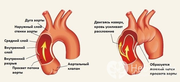 Коварная аневризма аорты сердца — что это такое, как диагностировать и вылечить?