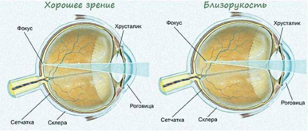 Гиперметропия: что это такое, виды средней степени у ребенка, признаки свидетельствующие о наличии, дальнозоркость обоих глаз у детей