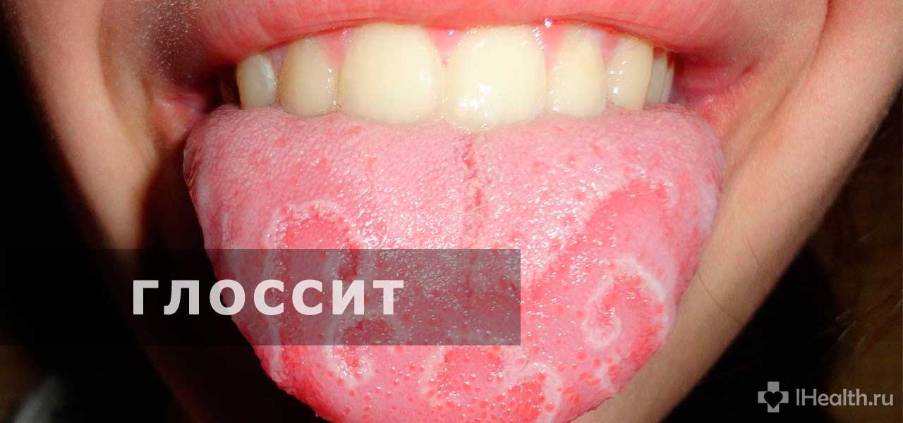 Воспаление кончика языка причины и лечение