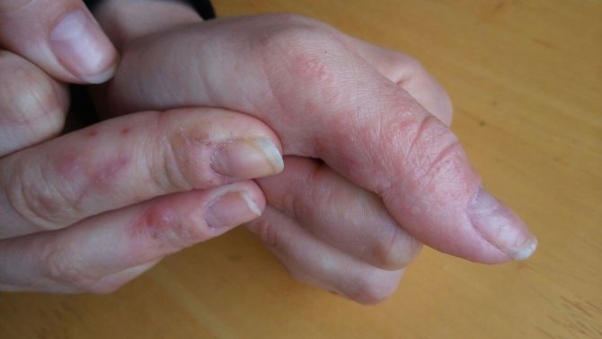 Как избавляться от заусенцев на пальцах? причины появления и методы лечения