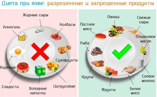 Лечебная диета «стол 1»: особенности питания при язвенной болезни желудка