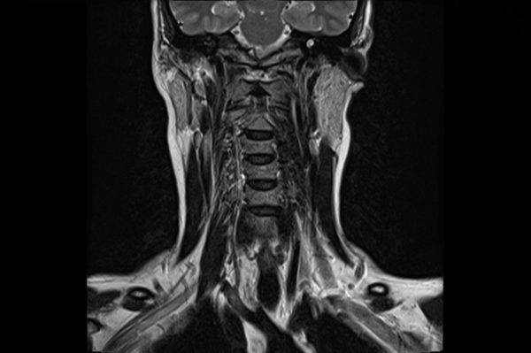 Что такое мрт шейного отдела позвоночника с контрастированием