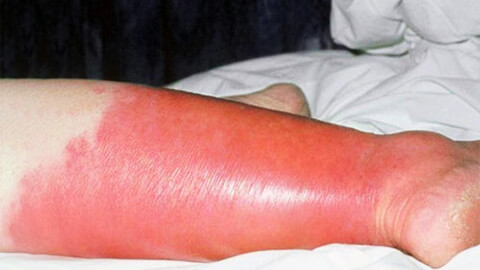 Рожа (рожистое воспаление) ноги, руки, лица: симптомы и признаки