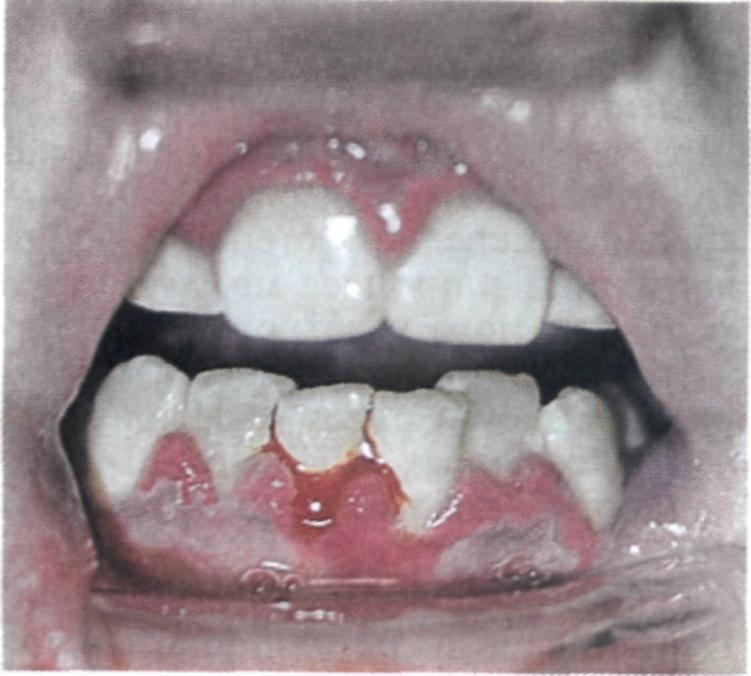 Почему чернеют зубы?