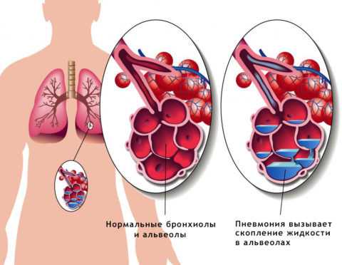 Внебольничная пневмония: диагностика, лечение. профилактика внебольничной пневмонии