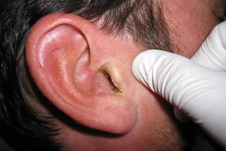Отит среднего уха симптомы, методы лечения и возможные осложнения