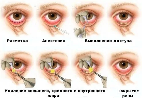 Грыжи под глазами: лечение и профилактика, удаление