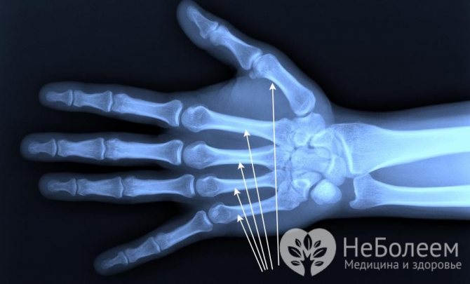 Перелом лучевой кости руки (перелом луча в типичном месте)