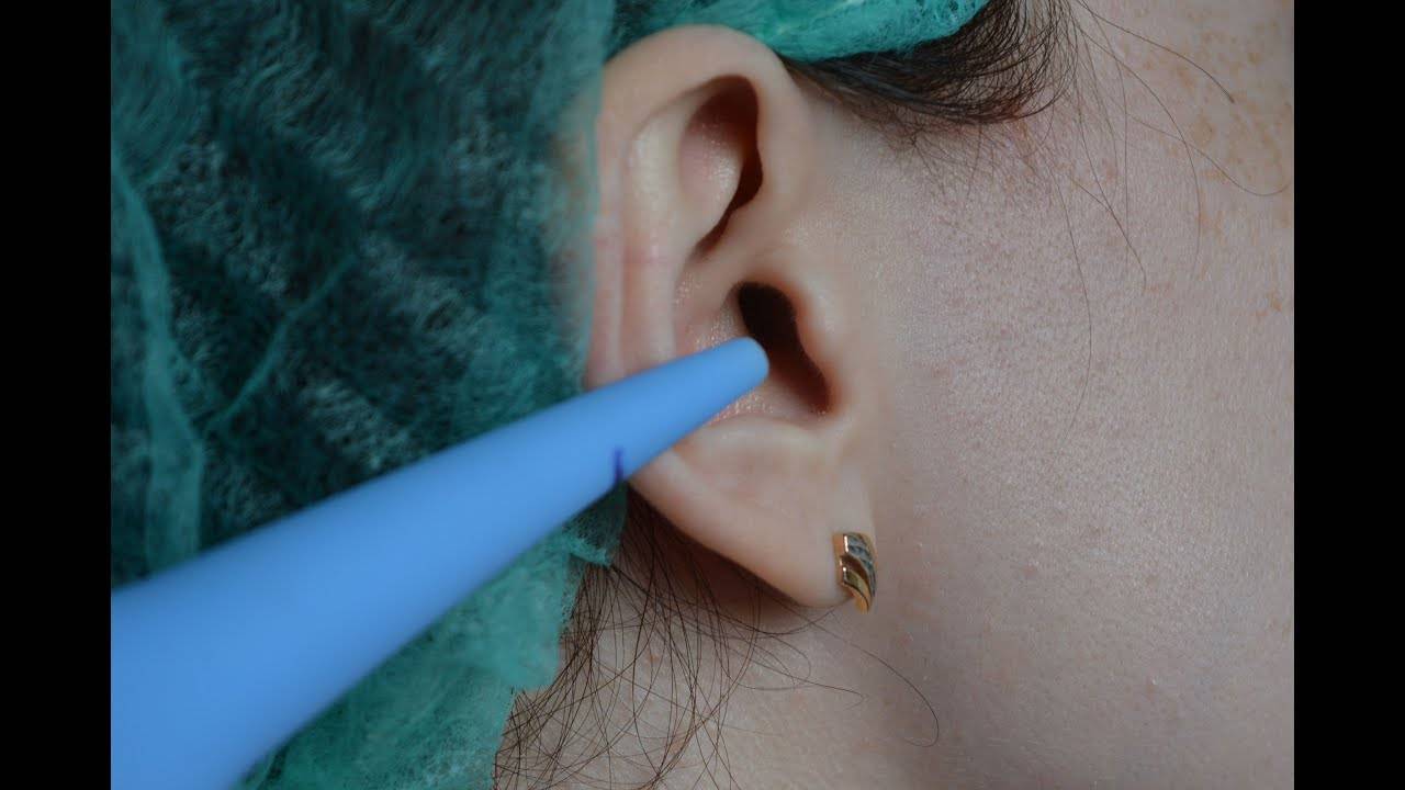 Ушная пробка у ребенка: симптомы, как избавиться и удалить в домашних условиях, как выглядит