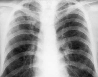 Виды очагового туберкулеза лёгких: заразен он или нет, как излечиться