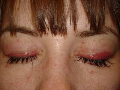 Причины красных глаз после наращивания ресниц, что в этом случае делать?
