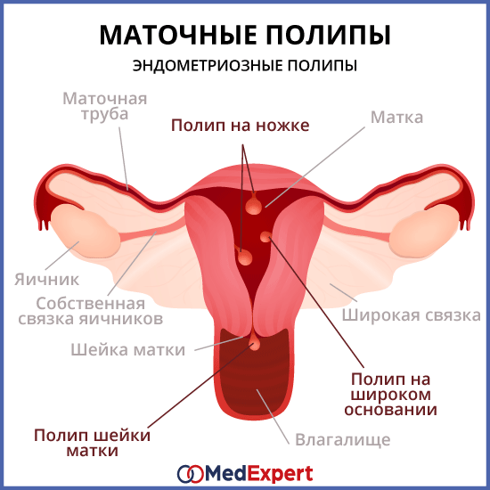Полип матки (эндометрия): причины, чем опасен, симптомы и выявление, лечение