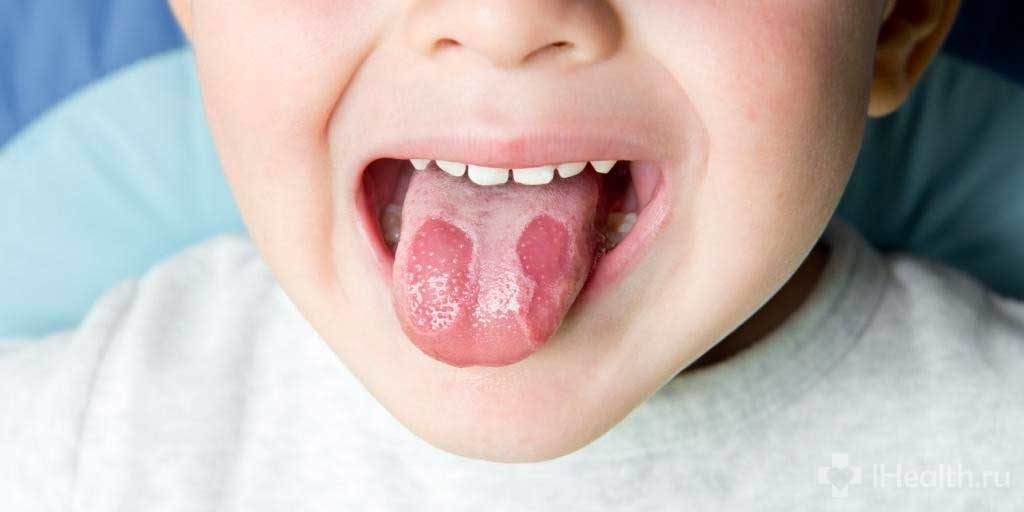 Воспаление языка — причины, симптомы, лечение. как лечить воспаление ротовой полости и языка?