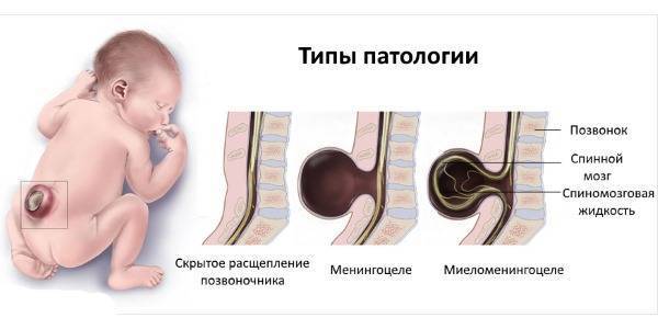 Спина бифида у новорожденных детей