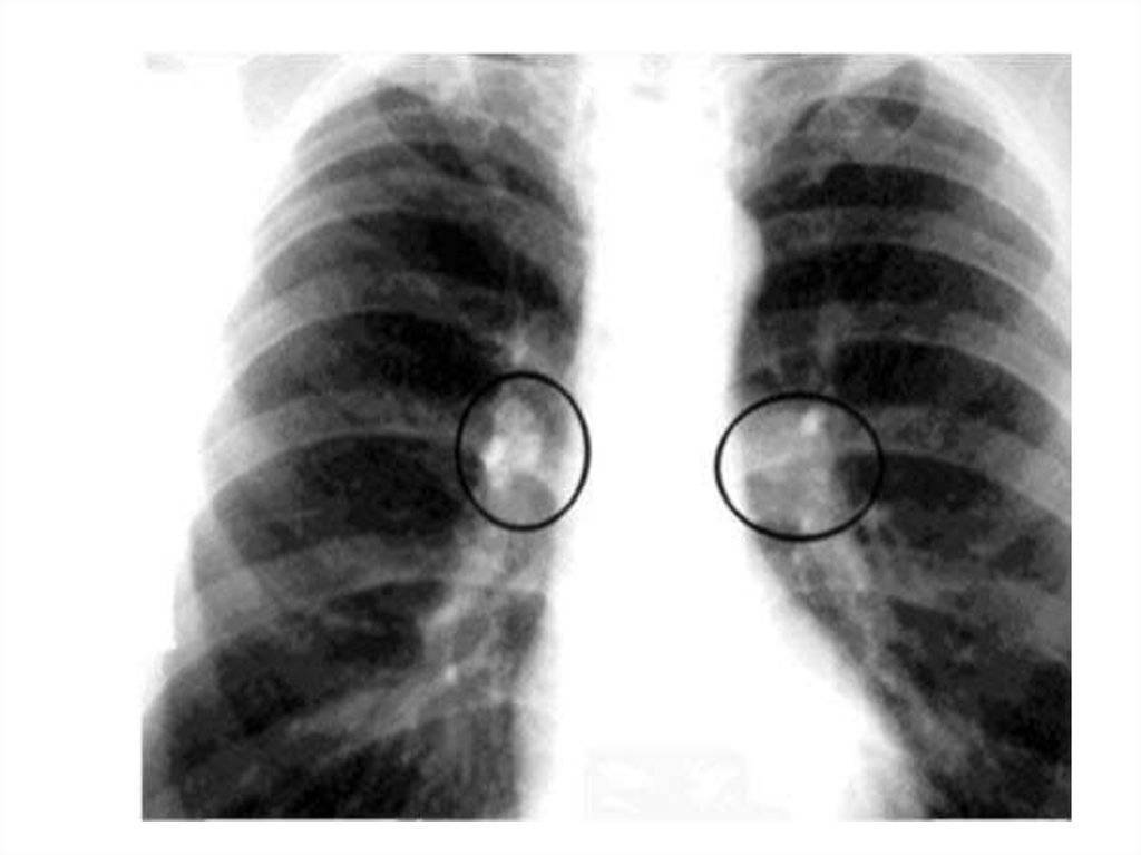 Узлы в легких что это. Малая форма туберкулеза внутригрудных лимфатических узлов рентген. Туберкулез внутригрудных лимфатических узлов рериген. Туберкулез внутригрудных лимфатических узлов рентген. Проявление туберкулеза внутригрудных лимфатических узлов рентген:.