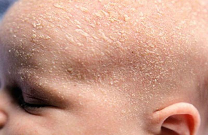 Себорея кожи головы у детей лечение