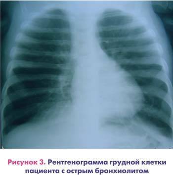 Бронхит на снимке. Острый бронхит у детей рентген. Бронхиолит на рентгенограмме. Острый бронхиолит рентген. Острый бронхит на снимке.