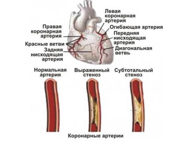 Передняя нисходящая артерия. Стеноз передней нисходящей артерии. Диагональная ветвь коронарной артерии. Огибающая ветвь коронарной артерии. Левая передняя нисходящая коронарная артерия.