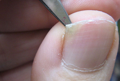 Удаление ногтевой пластины на ноге: показания, способы удаления, лечение после операции