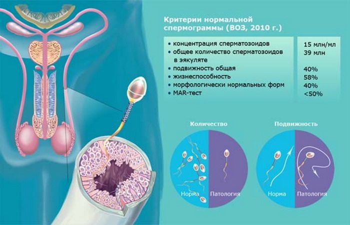 Варикоцеле, спермограмма