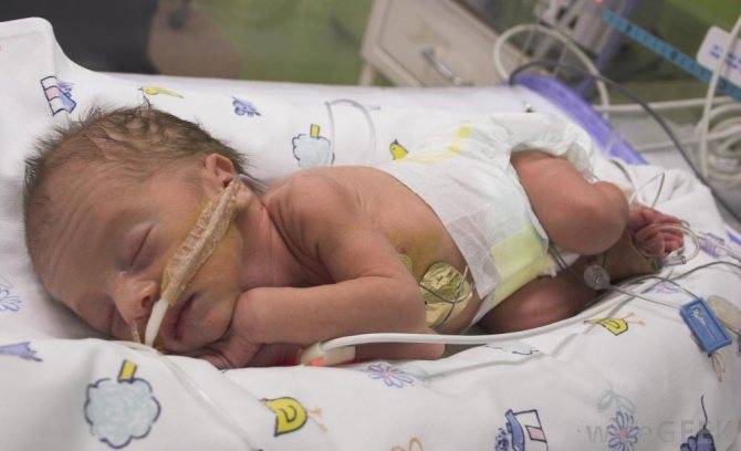 Пневмония новорожднных виды причины возникновения лечение и последствия