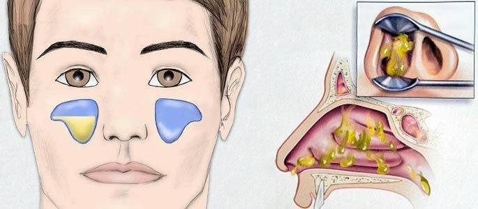 При гайморите желтые сопли что значит