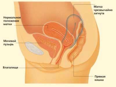 Спайки кишечника и спайки в области малого таза у женщин (спайки матки, маточных труб яичников): ответы на основные вопросы