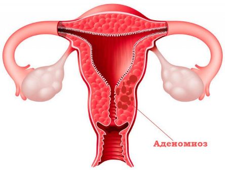 Аденомиоз матки: симптомы, диагностика, лечение — спросиврача