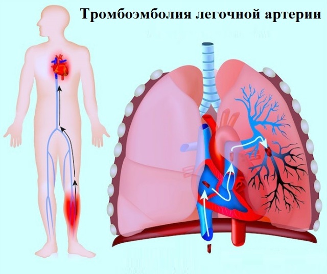 Тромбоэмболия | симптомы | диагностика | лечение - docdoc.ru