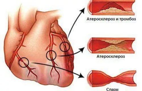 5 признаков приближения инфаркта