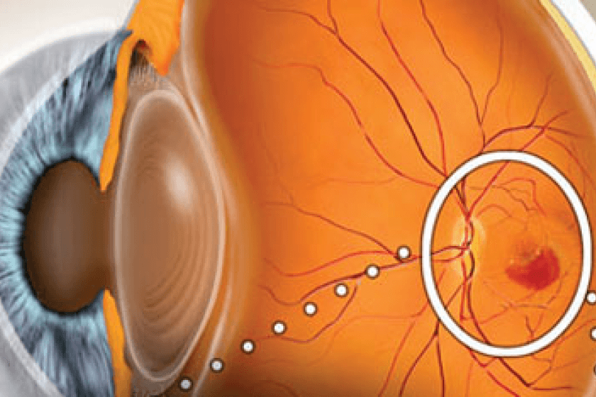 Макулодистрофия глаза: симптомы и причины заболевания, лечение сухой и влажной макулодистрофии сетчатки глаза