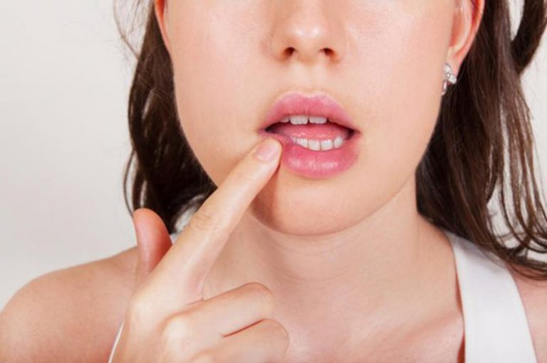 Чем лечить заеды на губах - причины