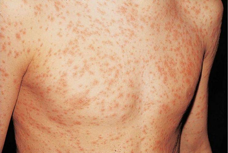 Аллергия на лекарства: фото, симптомы, как выглядят высыпания на коже