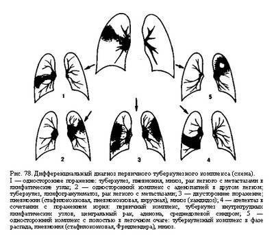 Вопросы диагностики и дифференциальной диагностики туберкулеза органов дыхания в современных условиях