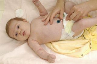 Кровит пупок у новорождённого: насколько это опасно, что это значит. что делать, если кровит пупок у новорождённого