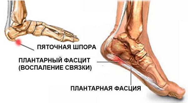 Удалить остеофиты на позвоночнике