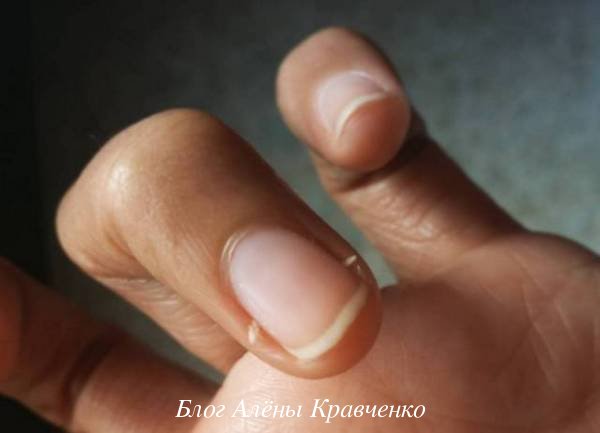 Заусенцы на пальцах рук: причины и лечение