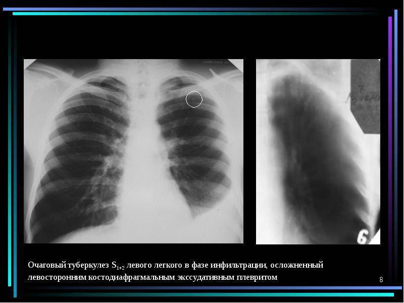 Заразен ли туберкулез на начальной стадии. очаговый туберкулез легких: заразен или нет, лечение, симптомы, сколько лечиться и как передается