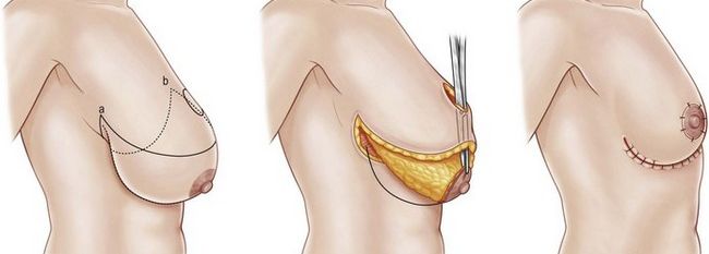 Маленькая грудь. маммопластика для увеличения груди: как проходит, сколько стоит, реабилитация, показания и противопоказания