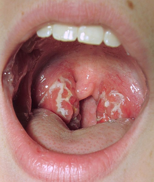Грибок в горле (кандидоз): причины, симптомы и лечение