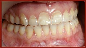Факторы влияющие на цвет зубов