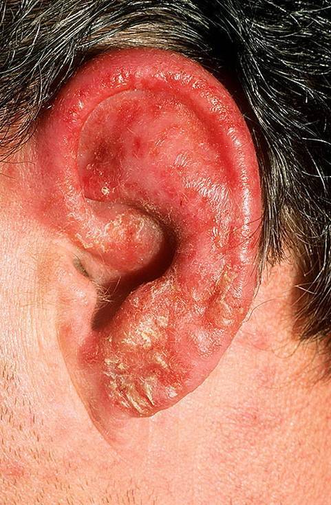 Противогрибковые капли в уши: чем вылечить грибок