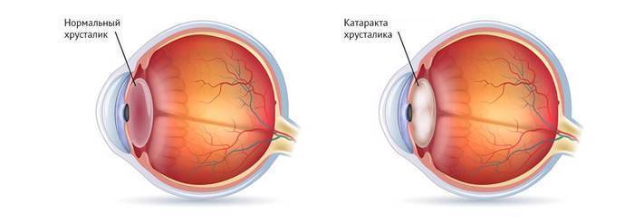 Как вести себя после операции по удалению катаракты глаза (замене хрусталика на иол)