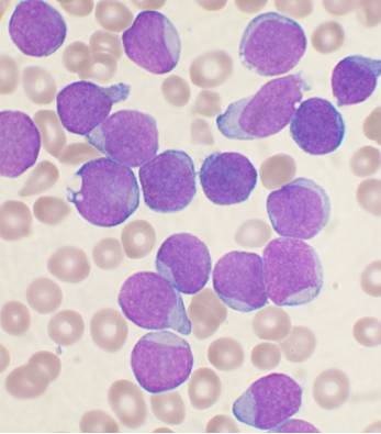 Лейкоз крови симптомы у взрослых анализ крови излечим или нет