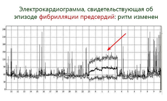 Ритмокор (rhythmocor)