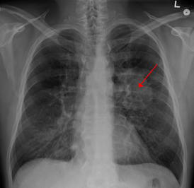 Рентген легких при туберкулезе: инфильтративном, милиарном, очаговом