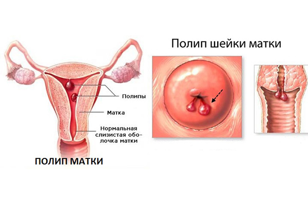 Аденоматозный полип эндометрия