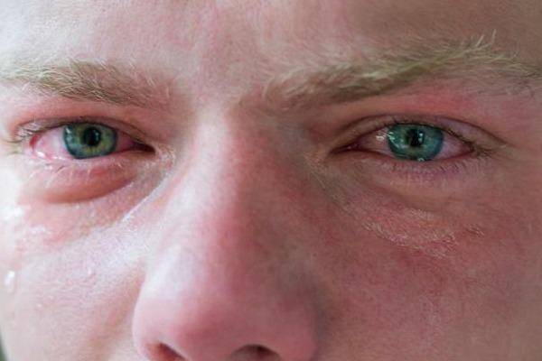Аллергия глаза чешутся и опухают веки