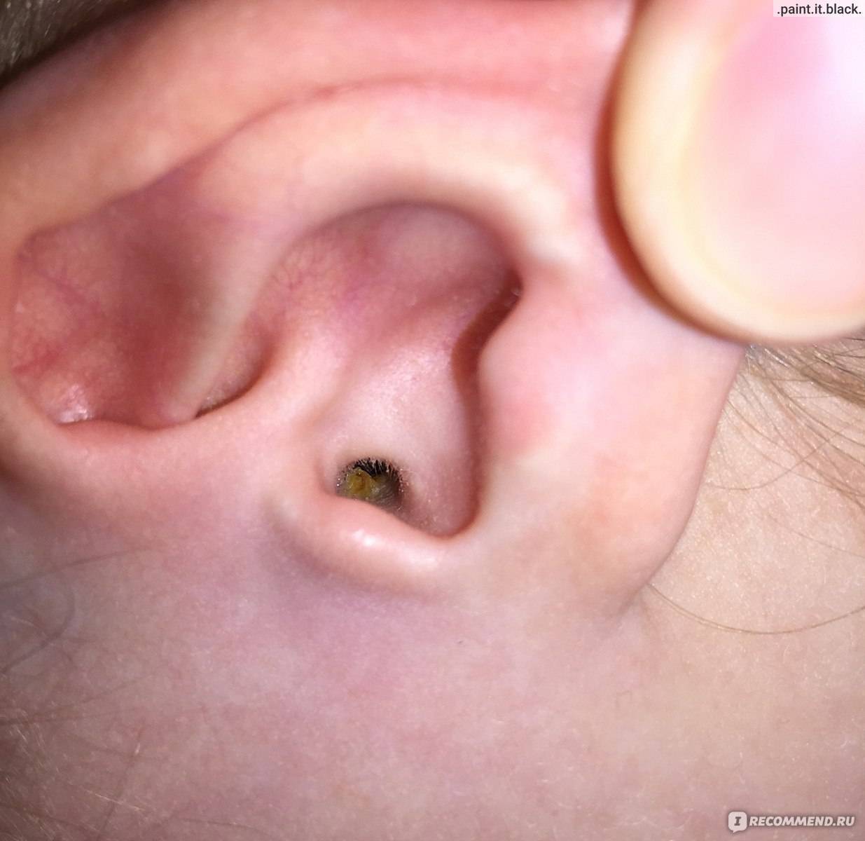 Серная пробка в ухе у ребенка (25 фото): как выглядит пробка в ухе и как вытащить ее в домашних условиях, почистить ухо и удалить ее самостоятельно