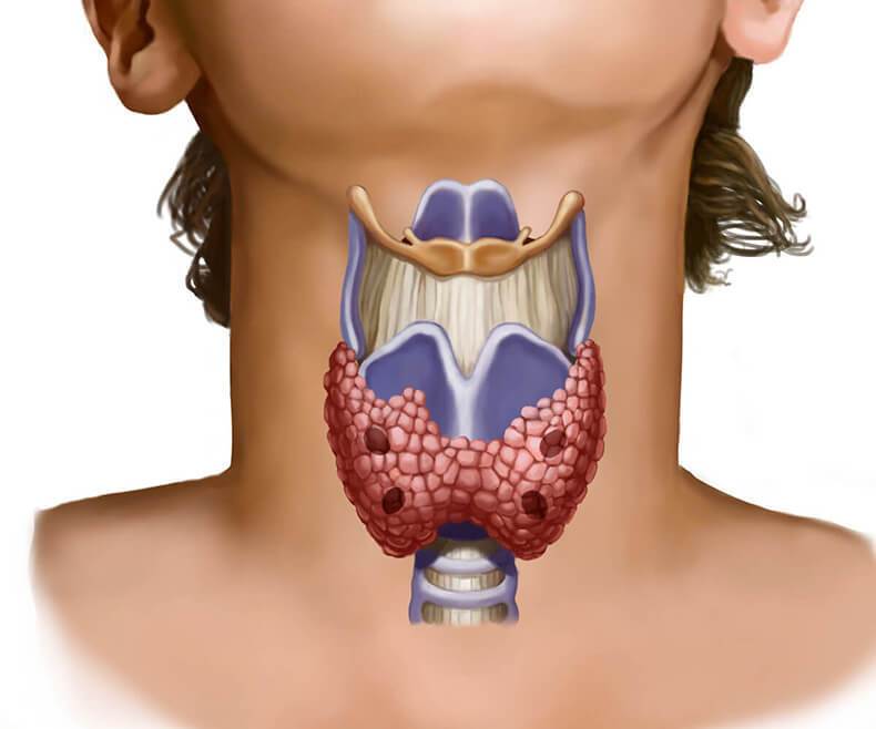 Рак щитовидной железы. симптомы, признаки, причины, диагностика и лечение заболевания.